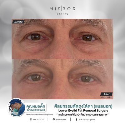 Upper / Lower Eyelids