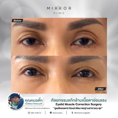 Upper / Lower Eyelids