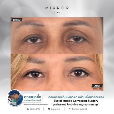 Upper / Lower Eyelids