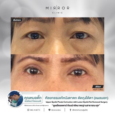 Upper / Lower Eyelids