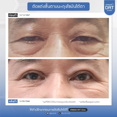 รีวิวแก้ไขศัลยกรรมตา