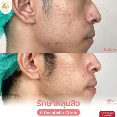 รวมรูปรีวิวโปรแกรมรักษาหลุมสิว
