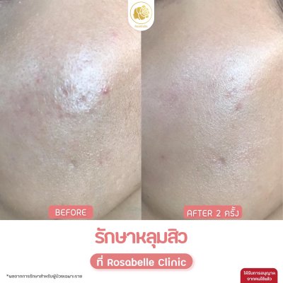 รวมรูปรีวิวโปรแกรมรักษาหลุมสิว