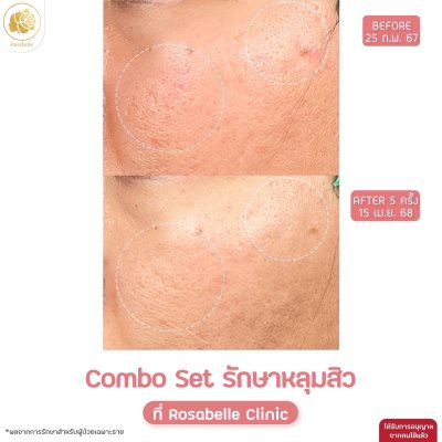 รวมรูปรีวิวโปรแกรมรักษาหลุมสิว