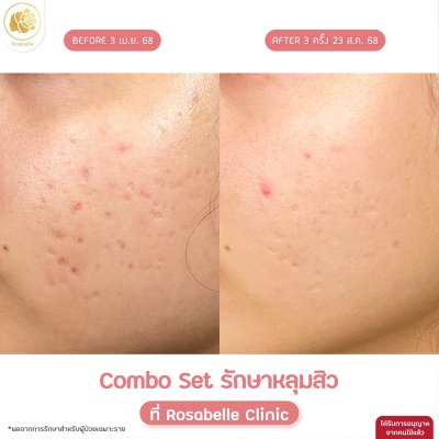 รวมรูปรีวิวโปรแกรมรักษาหลุมสิว