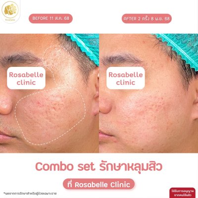 รวมรูปรีวิวโปรแกรมรักษาหลุมสิว