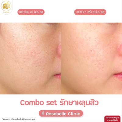 รวมรูปรีวิวโปรแกรมรักษาหลุมสิว