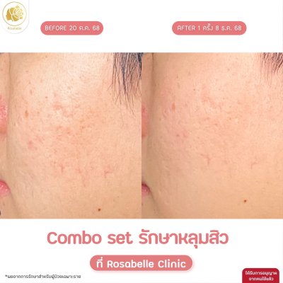 รวมรูปรีวิวโปรแกรมรักษาหลุมสิว