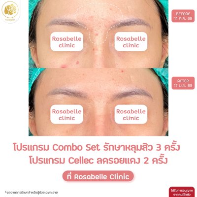 รวมรูปรีวิวโปรแกรมรักษาหลุมสิว