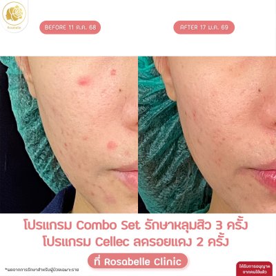 รวมรูปรีวิวโปรแกรมรักษาหลุมสิว