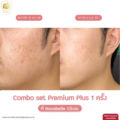 รีวิวโปรแกรม Combo Set Premium Plus หลุมสิว