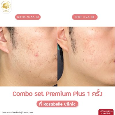 รีวิวโปรแกรม Combo Set Premium Plus หลุมสิว