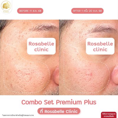 รีวิวโปรแกรม Combo Set Premium Plus หลุมสิว