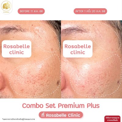 รีวิวโปรแกรม Combo Set Premium Plus หลุมสิว