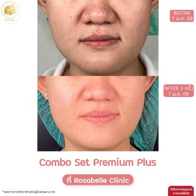 รีวิวโปรแกรม Combo Set Premium Plus หลุมสิว