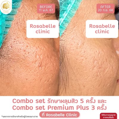 รีวิวโปรแกรม Combo Set Premium Plus หลุมสิว