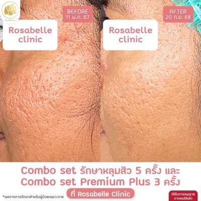 รีวิวโปรแกรม Combo Set Premium Plus หลุมสิว