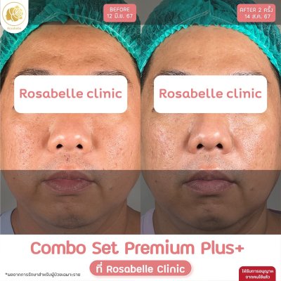 รีวิวโปรแกรม Combo Set Premium Plus หลุมสิว