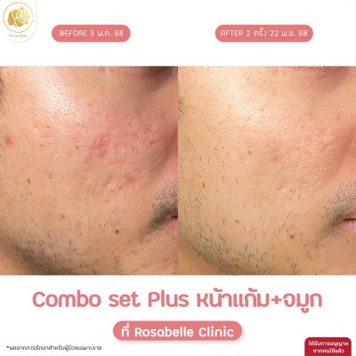 รีวิวโปรแกรม Combo Set Plus หลุมสิว