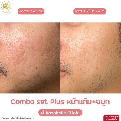 รีวิวโปรแกรม Combo Set Plus หลุมสิว