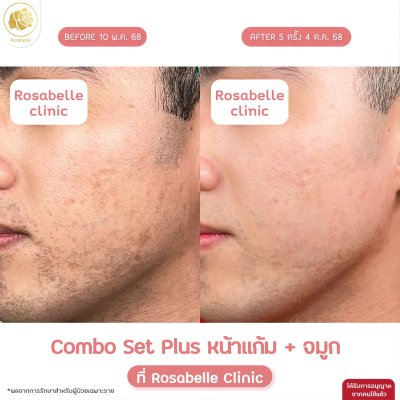 รีวิวโปรแกรม Combo Set Plus หลุมสิว