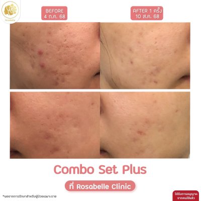 รีวิวโปรแกรม Combo Set Plus หลุมสิว