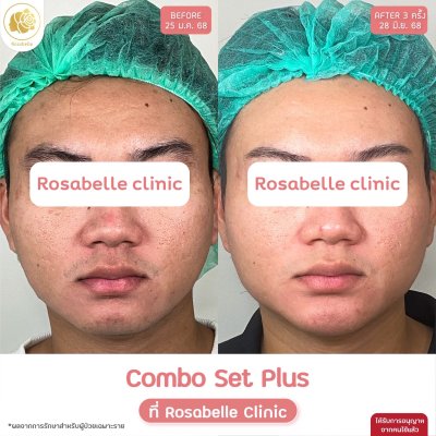รีวิวโปรแกรม Combo Set Plus หลุมสิว