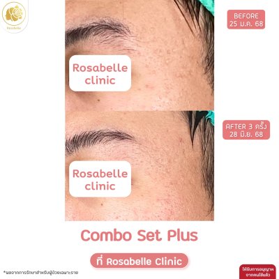 รีวิวโปรแกรม Combo Set Plus หลุมสิว
