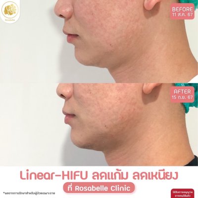 รีวิวโปรแกรม Linear-HIFU