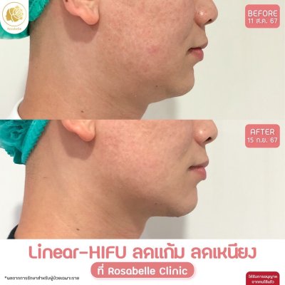 รีวิวโปรแกรม Linear-HIFU