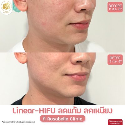 รีวิวโปรแกรม Linear-HIFU