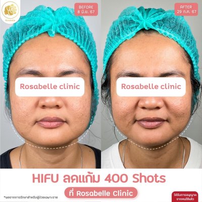 รีวิวโปรแกรม Linear-HIFU