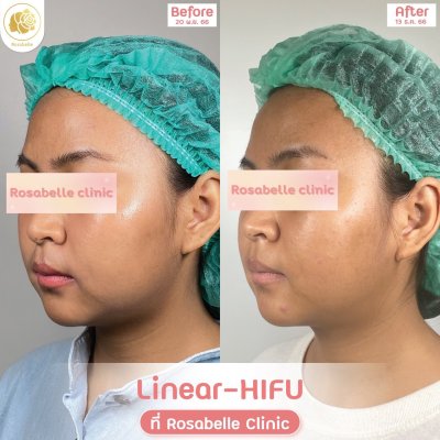 รีวิวโปรแกรม Linear-HIFU