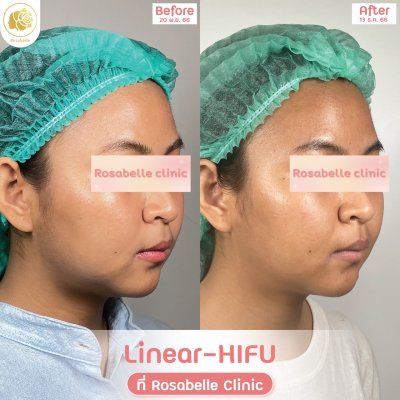 รีวิวโปรแกรม Linear-HIFU