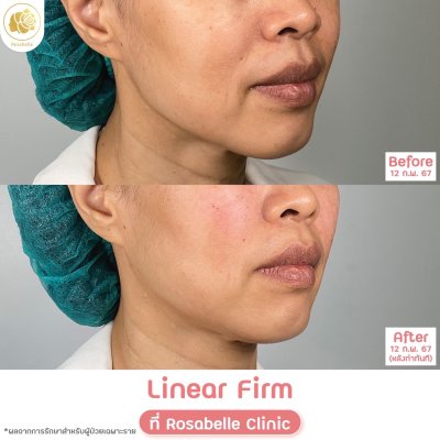 รีวิวโปรแกรม Linear-HIFU