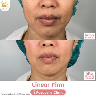 รีวิวโปรแกรม Linear-HIFU