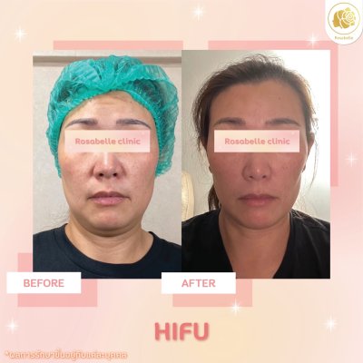 รีวิวโปรแกรม Linear-HIFU