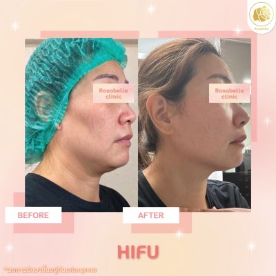 รีวิวโปรแกรม Linear-HIFU