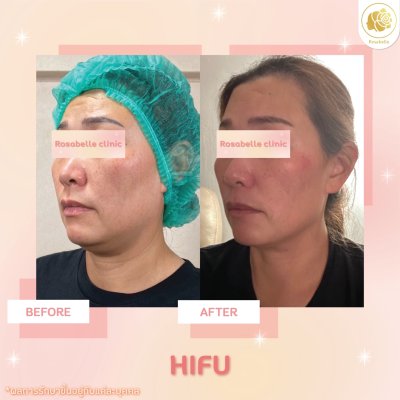 รีวิวโปรแกรม Linear-HIFU