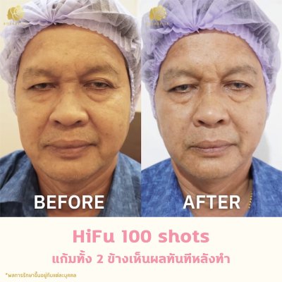 รีวิวโปรแกรม Linear-HIFU