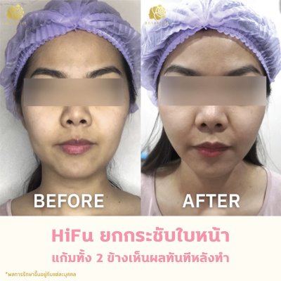 รีวิวโปรแกรม Linear-HIFU