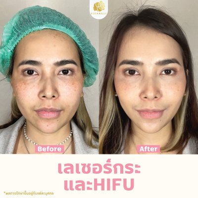 รีวิวโปรแกรม Linear-HIFU