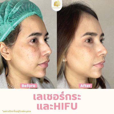 รีวิวโปรแกรม Linear-HIFU