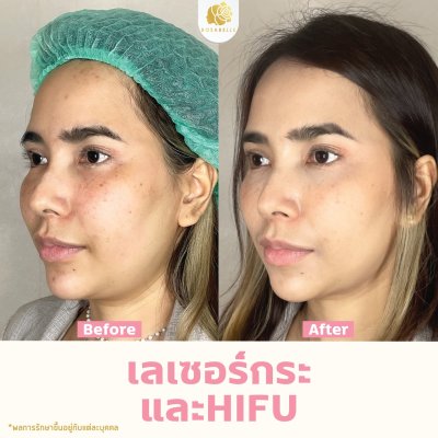 รีวิวโปรแกรม Linear-HIFU