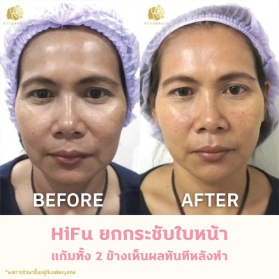 รีวิวโปรแกรม Linear-HIFU