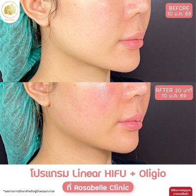 รีวิวโปรแกรม Linear-HIFU & โปรแกรม Oligio  