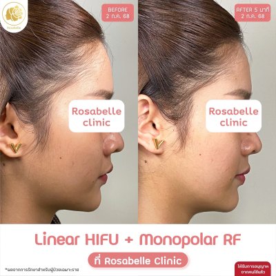 รีวิวโปรแกรม Linear-HIFU & โปรแกรม Oligio  