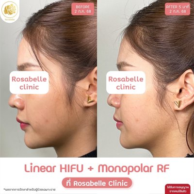 รีวิวโปรแกรม Linear-HIFU & โปรแกรม Oligio  