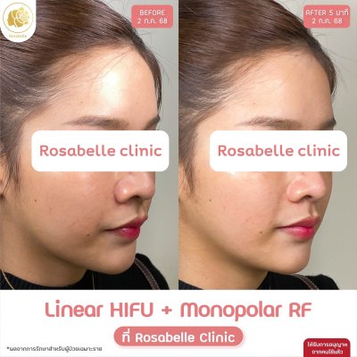 รีวิวโปรแกรม Linear-HIFU & โปรแกรม Oligio  