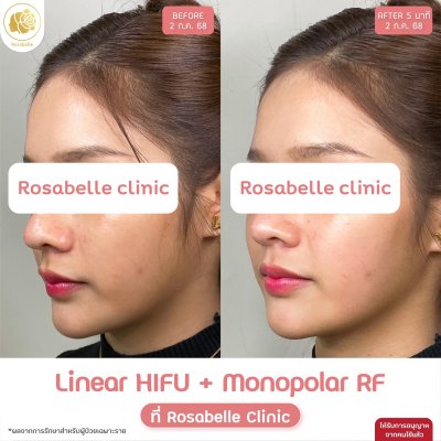 รีวิวโปรแกรม Linear-HIFU & โปรแกรม Oligio  